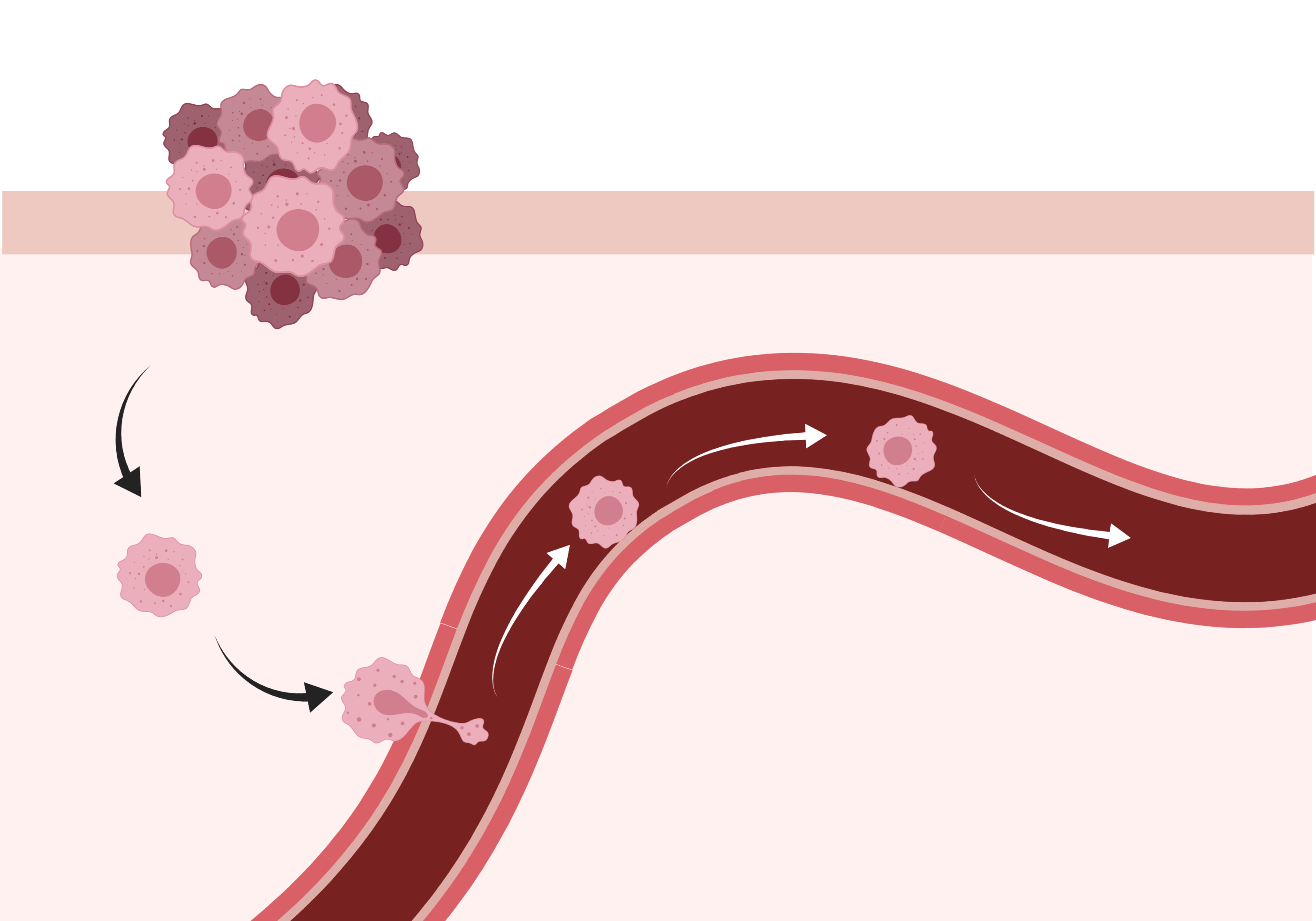 metastasis